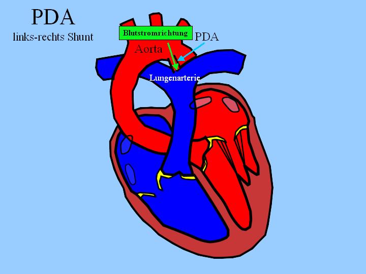 Persistierender Ductus arteriosus Botalli (PDA) Tierarztpraxis Dr
